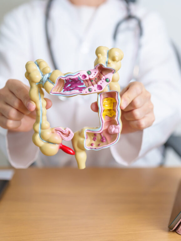 Doctor with human Colon anatomy model and tablet. Colonic disease, Large Intestine, Colorectal cancer, Ulcerative colitis, Diverticulitis, Irritable bowel syndrome and Digestive system